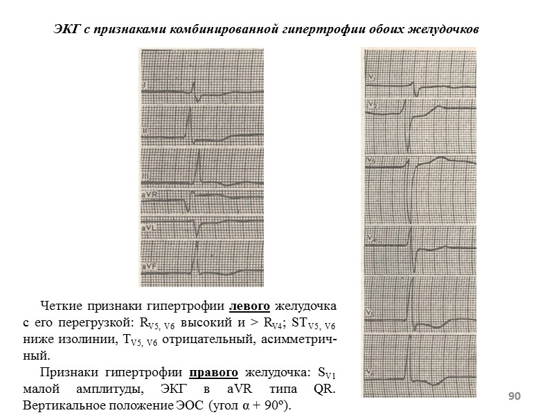 90 ЭКГ с признаками комбинированной гипертрофии обоих желудочков 90 ЭКГ с признаками комбинированной гипертрофии обоих желудочков